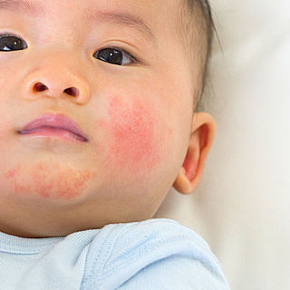 Eczema Types and How to Understand Them