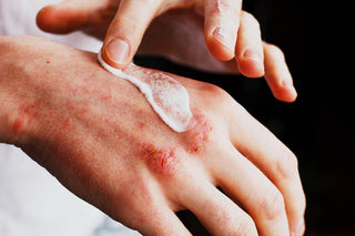 How Can Eczema Impact Mental Health?