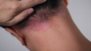 Is There an Effective Shampoo for Managing Psoriasis-Prone Scalps?